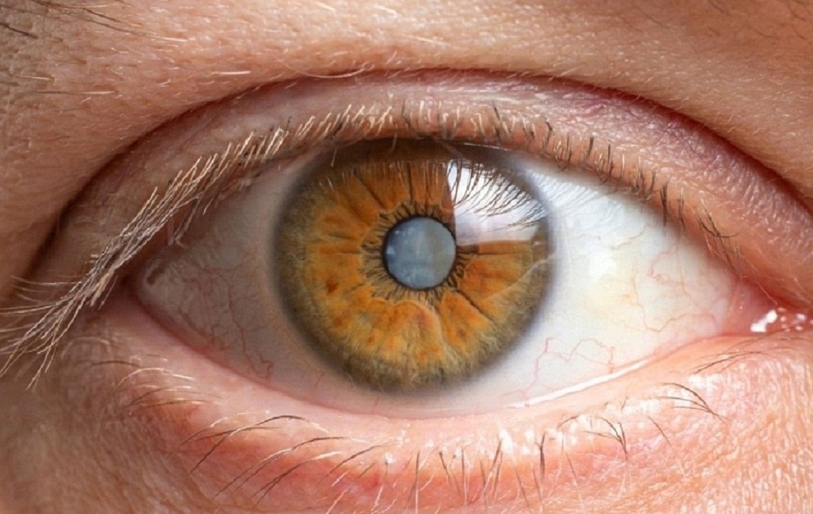 CATARACT :CURE AND PREVENTION.