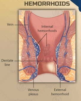 COMMON DISEASE “PILES”(HEMORRHOIDS)-REMEDIES