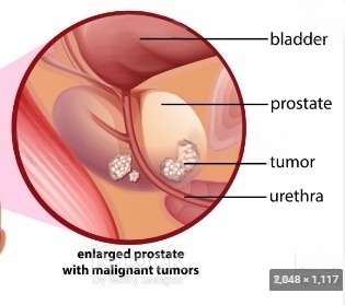 HOW YOU  CAN CURE PROSTATE CANCER