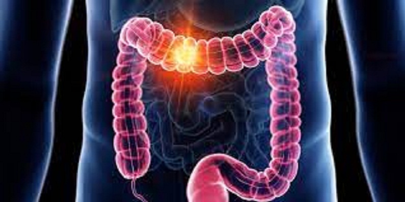 “PREVENTING COLON CANCER:LIFESTYLE CHANGES AND EARLY DETECTION.”