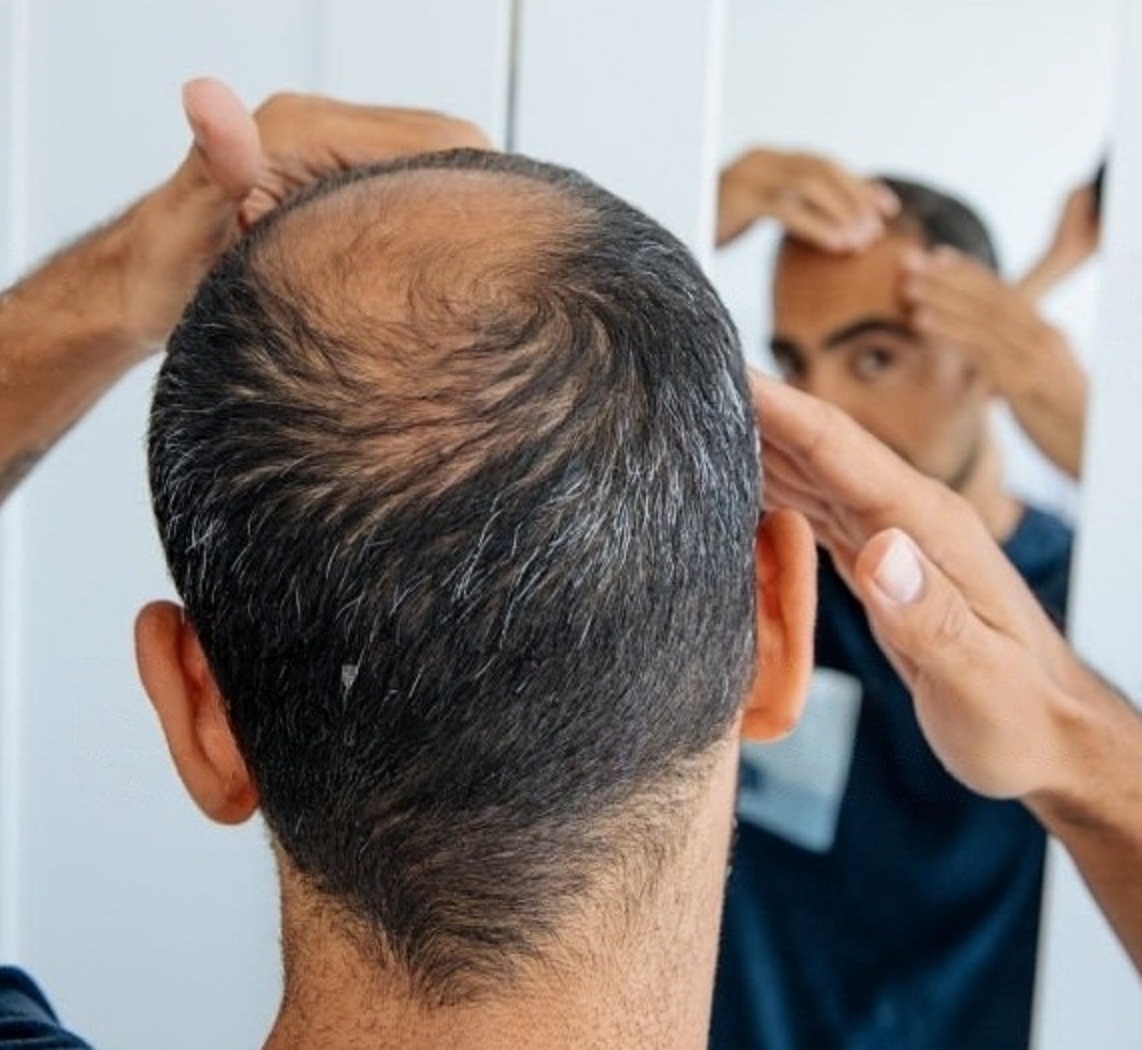 HAIR LOSS AND NUTRITION